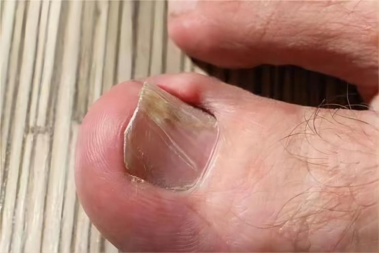 反甲脚趾甲变形图