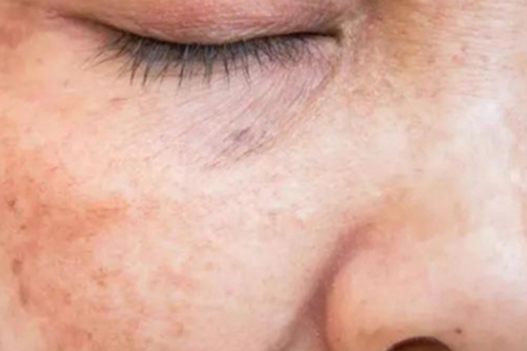 光老化眼周有很多细纹图