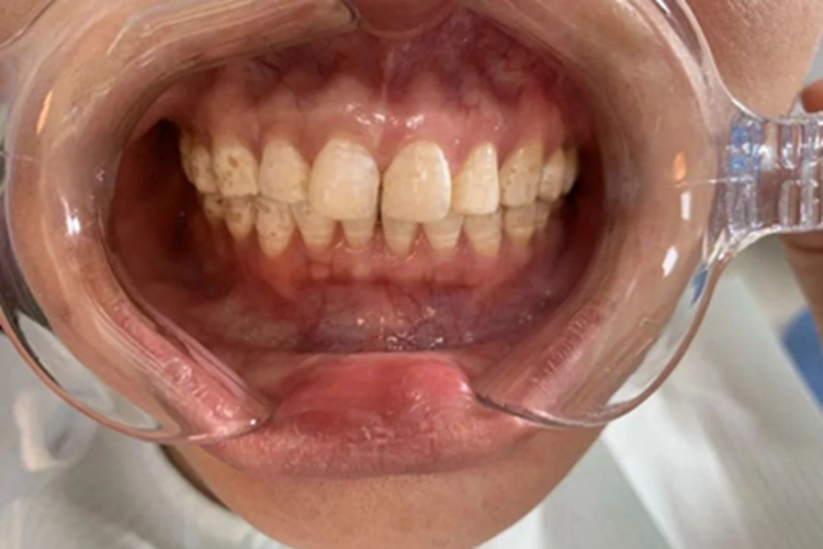 氟牙症牙齿斑点图