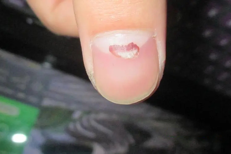 甲下外伤红点图