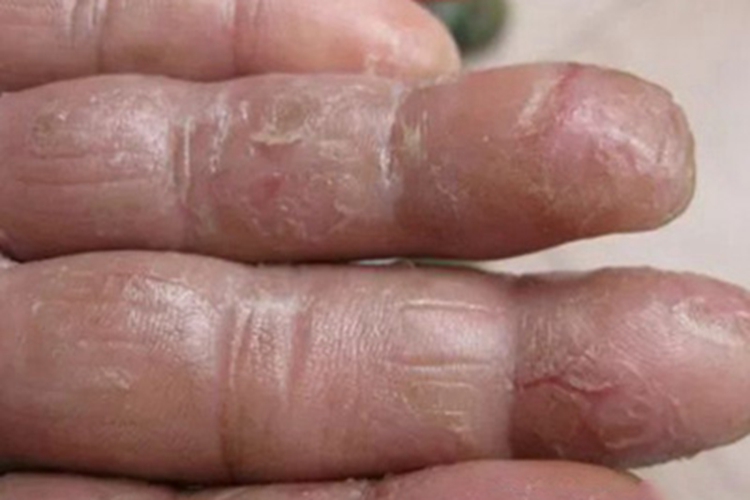 手足皲裂手指上有裂口图 手足皲裂手指上有裂口图