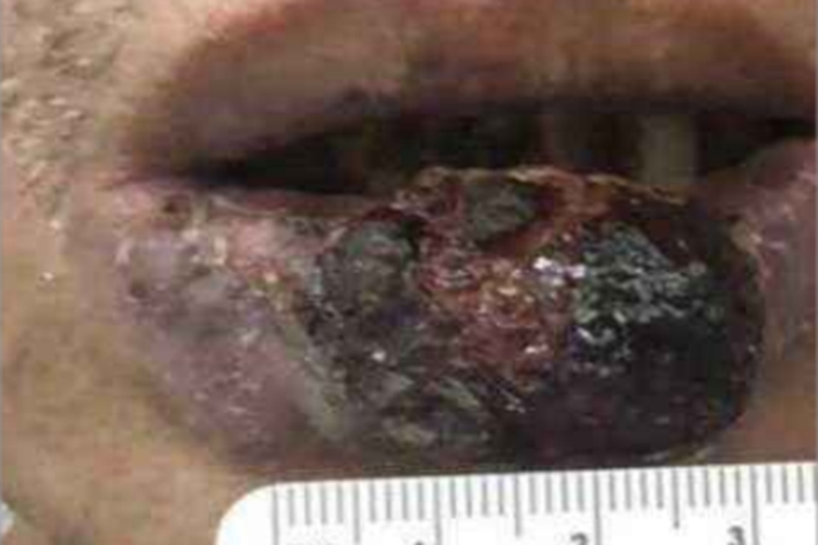 皮肤鳞状细胞癌嘴唇瘤图 皮肤鳞状细胞癌嘴唇瘤图