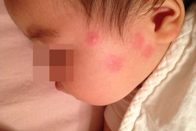 蚊虫叮咬图 蚊虫叮咬图