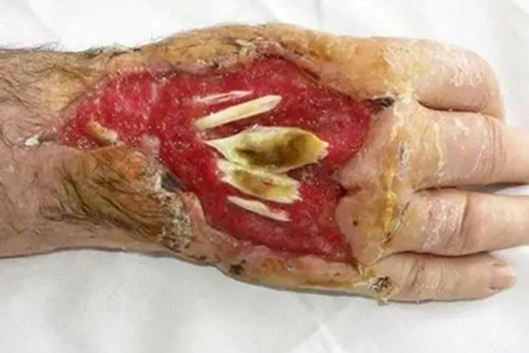 蜂窝织炎手背糜烂图 蜂窝织炎手背糜烂图