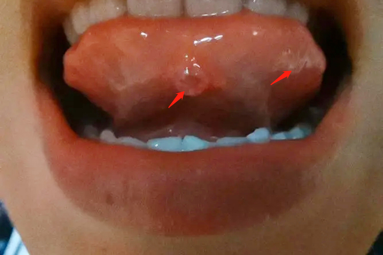 黏液囊肿舌尖下有疱图 黏液囊肿舌尖下有疱图