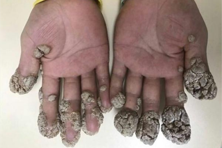 疣状表皮发育不良手指症状图