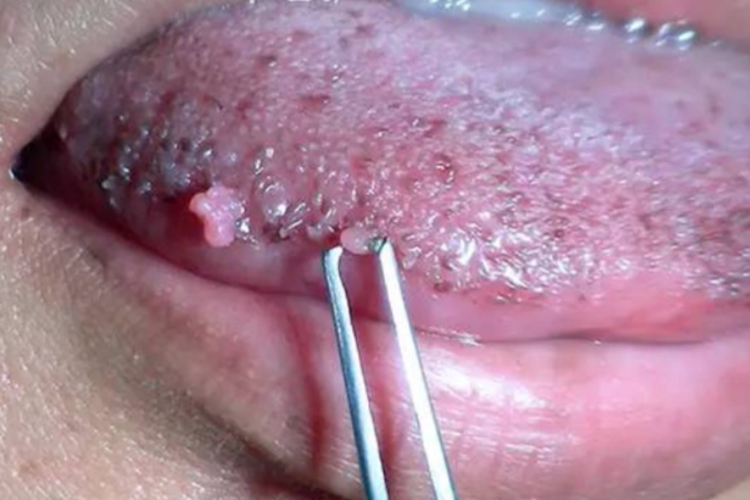 舌尖部位尖锐湿疣的图片