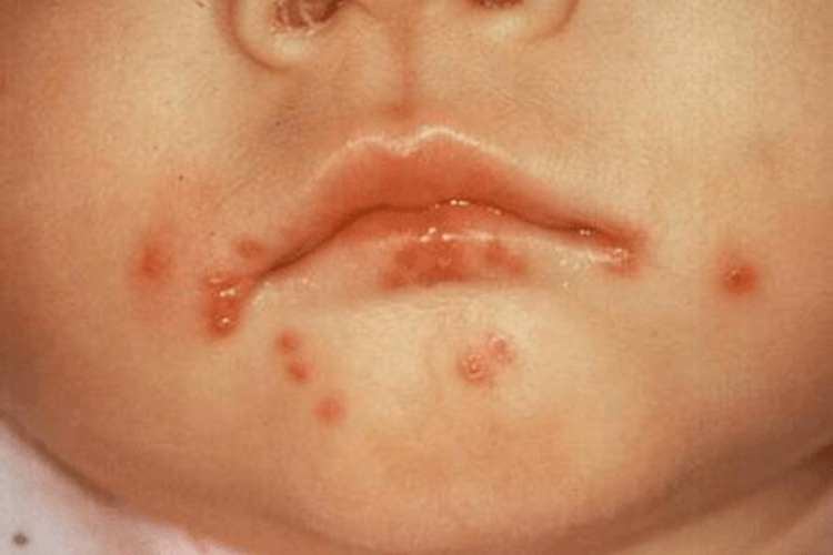 新生儿单纯疱疹图 新生儿单纯疱疹图