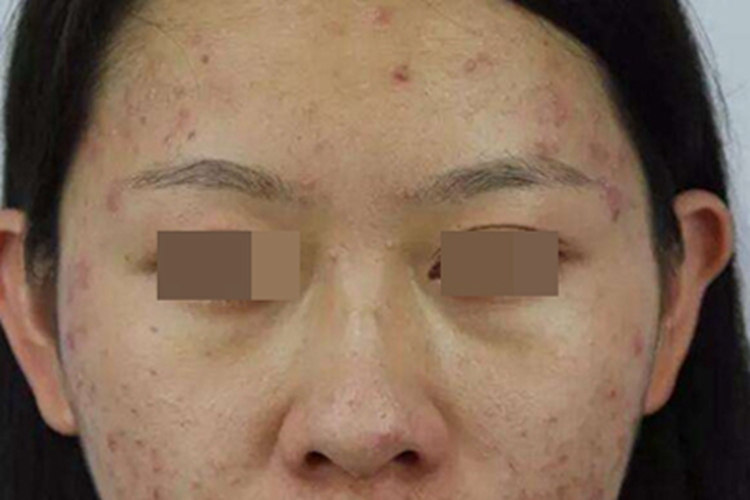 多囊卵巢综合征丘疹图