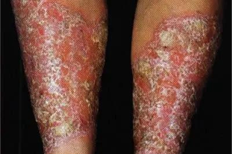 脓疱性肢端皮炎小腿症状图