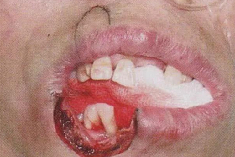 唇缺损嘴唇结痂图