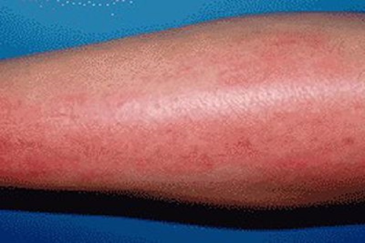 管状淋巴管炎图