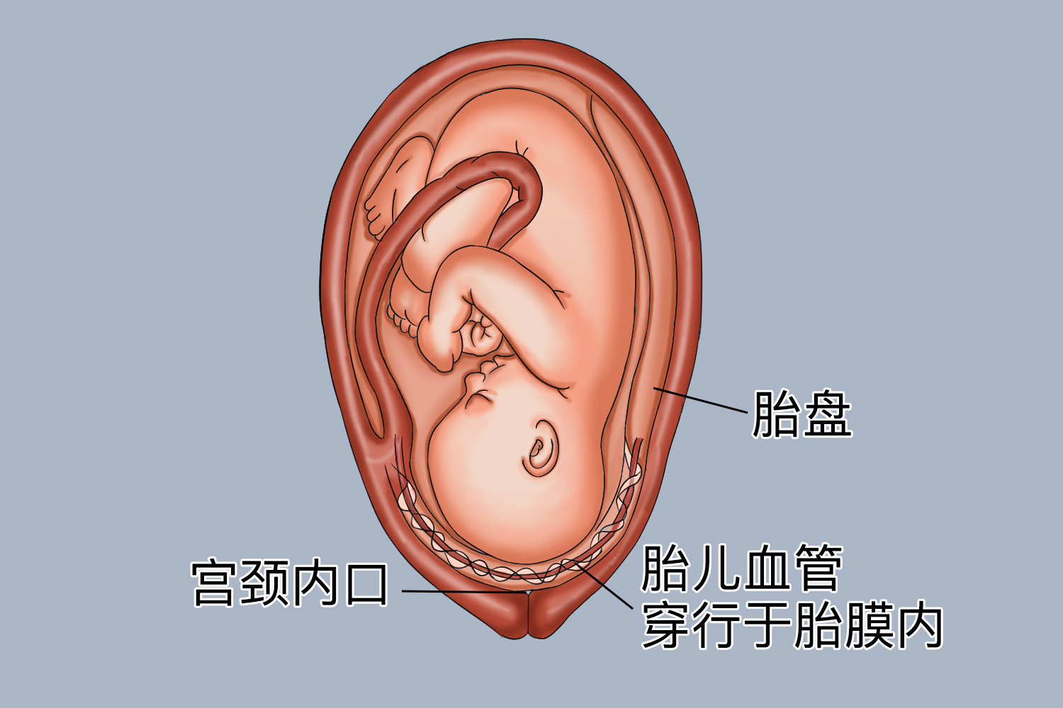 前置血管示意图 前置血管示意图