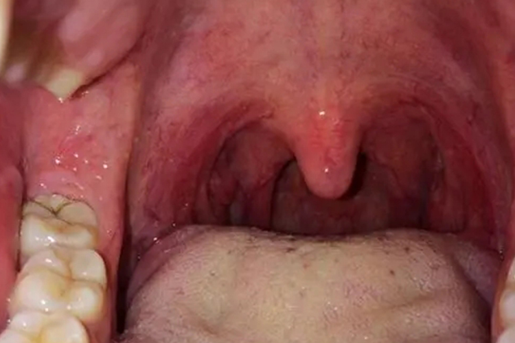 扁桃体化脓痊愈图