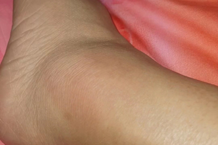 踝扭伤脚踝肿胀明显发红图