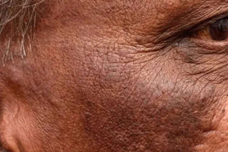 恶性黑棘皮病眼角症状图