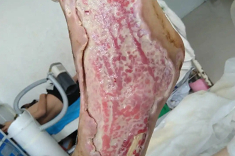 坏疽性臁疮脚部溃疡图 坏疽性臁疮脚部溃疡图