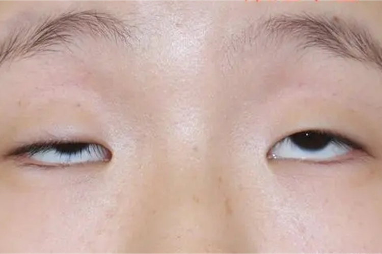 婴儿眼睑下垂图 婴儿眼睑下垂图