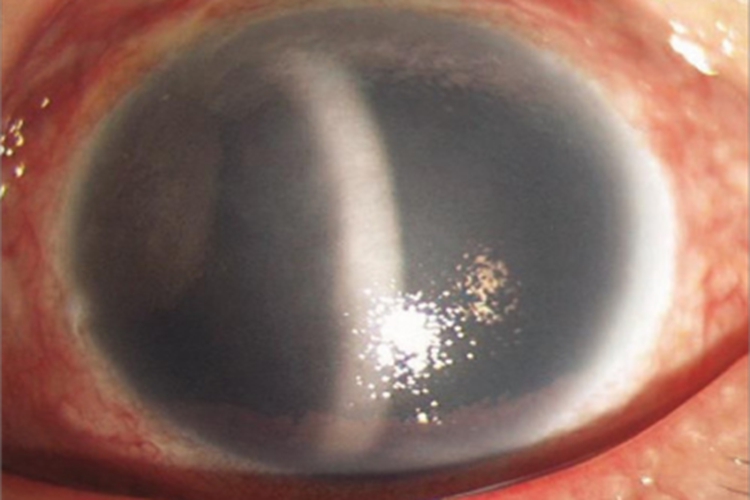 大泡性角膜病变眼球有弧形白斑图 大泡性角膜病变眼球有弧形白斑图