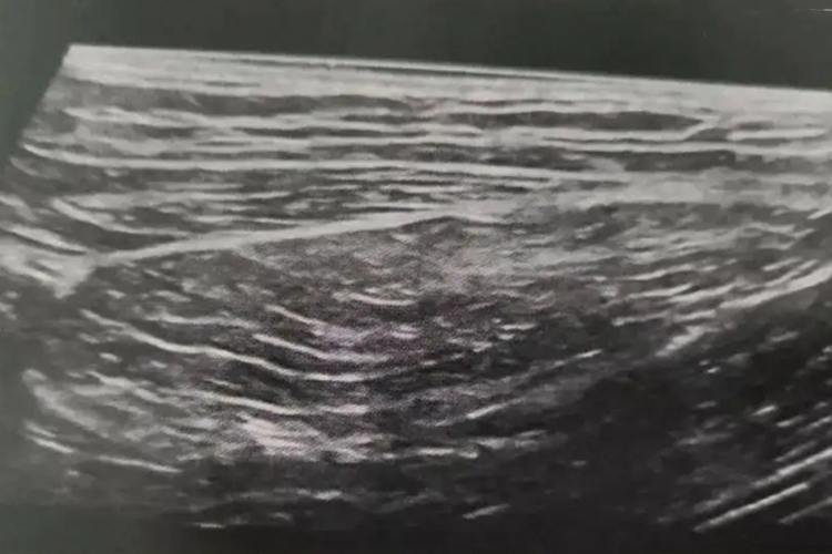 脂肪瘤B超声像图 脂肪瘤B超声像图