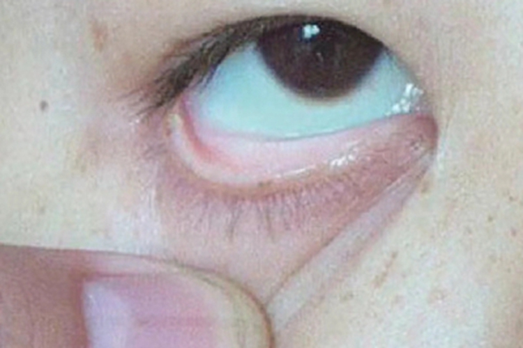 缺铁性贫血眼睑发白图