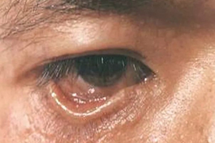 下睑外翻症状图