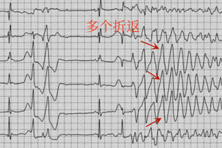 A型RonT现象心电图
