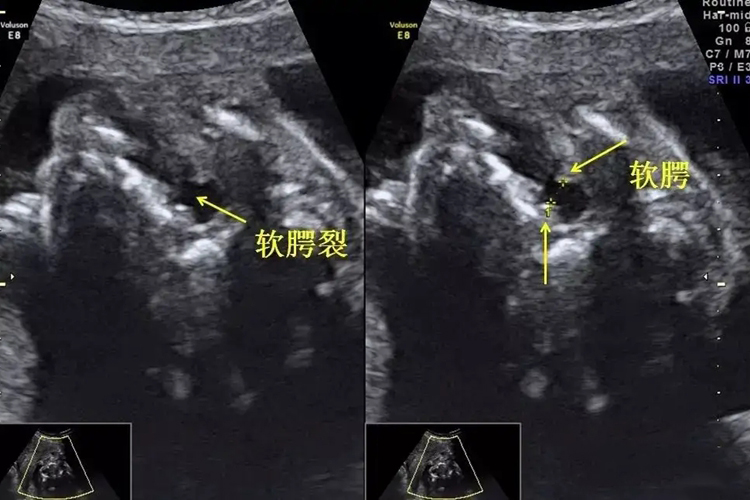 胎儿软腭裂超声图