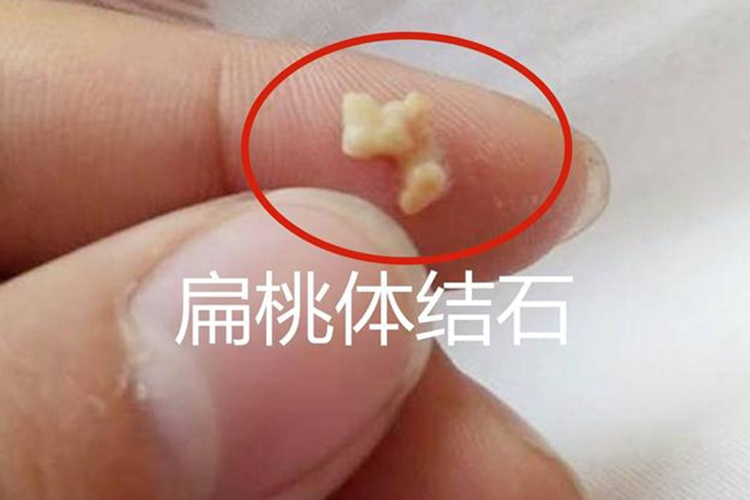 偶尔吐出扁桃体结石图
