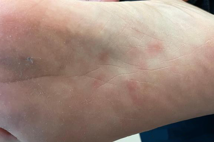 梅毒脚底梅毒疹图