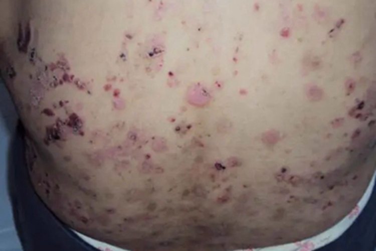 疱疹样天疱疮背部黑痂图