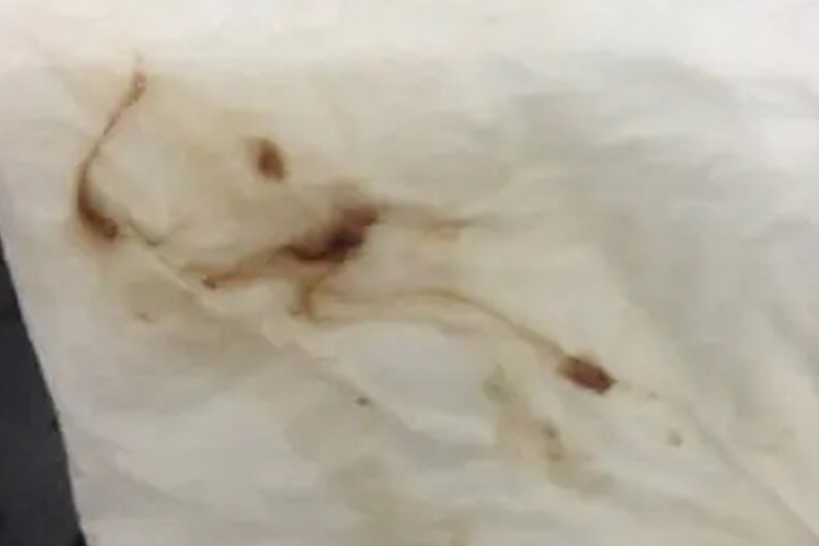 子宫内膜炎黑色白带图 子宫内膜炎黑色白带图