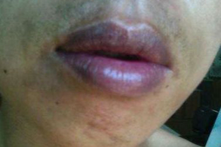 一氧化碳中毒皮肤发紫图