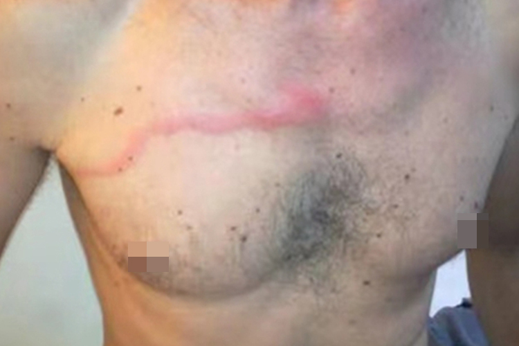 血栓性浅静脉炎胸部条纹图 血栓性浅静脉炎胸部条纹图