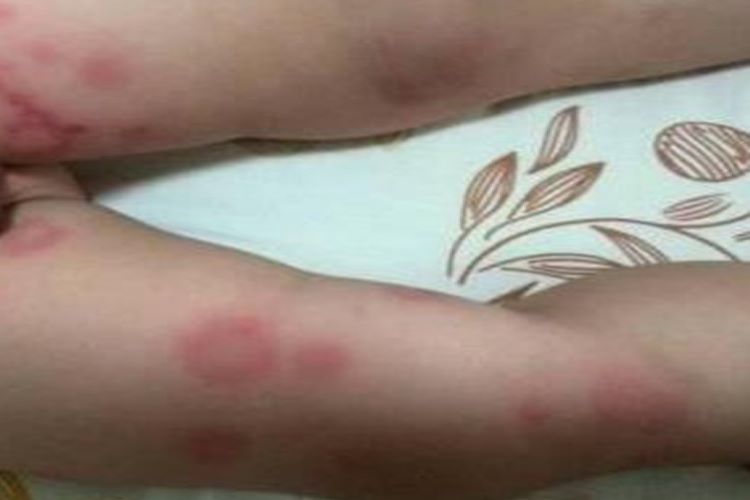 新生儿暂时性萎缩性回状红斑图