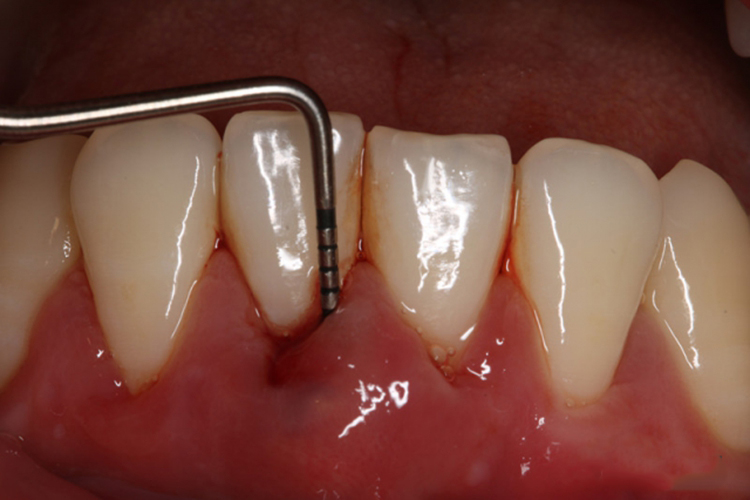 牙周脓肿牙肿图