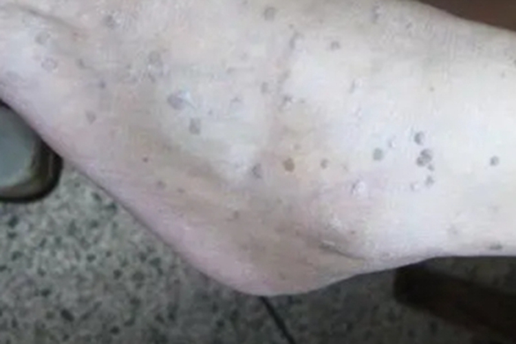 灰泥角化病脚背症状图