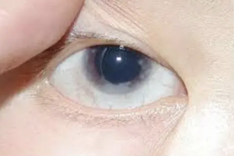 眼胀眼压升高图