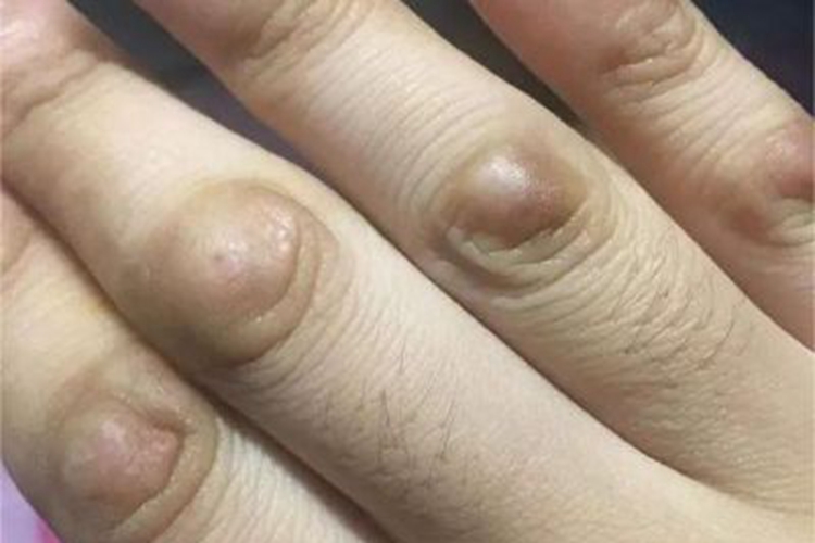 指节垫手指硬疙瘩图片