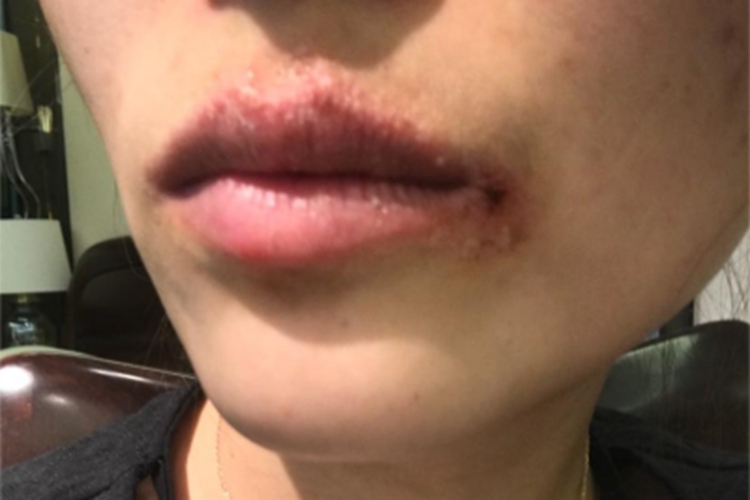 感染性口角炎嘴角发红结痂图