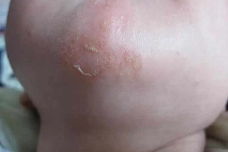 面癣下巴红斑图