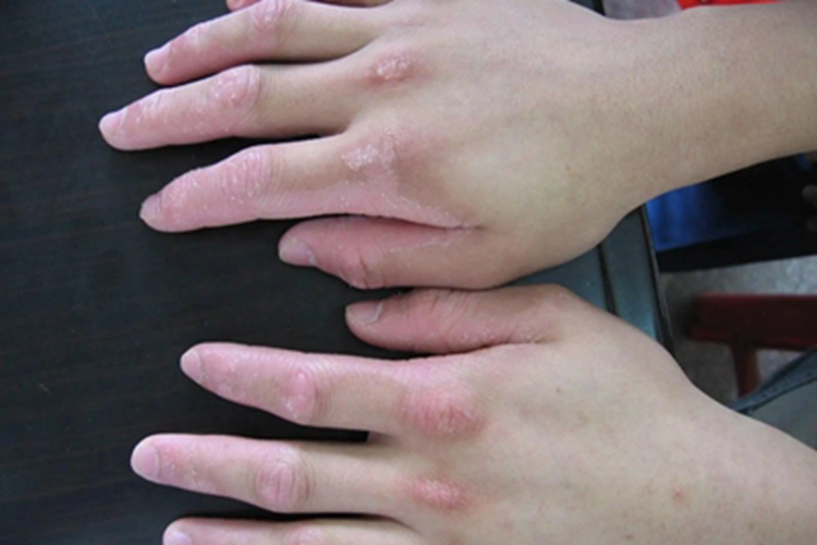 慢性苔藓样角化病手背皮肤粗糙图