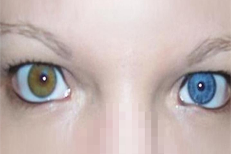 虹膜异色眼睛不同颜色图