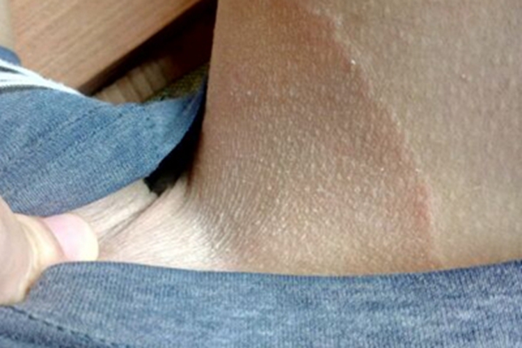 股癣大腿根大片浅红色斑块图 股癣大腿根大片浅红色斑块图