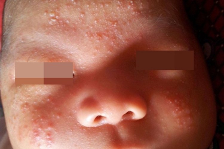 痤疮脸上长白头粉刺图 痤疮脸上长白头粉刺图