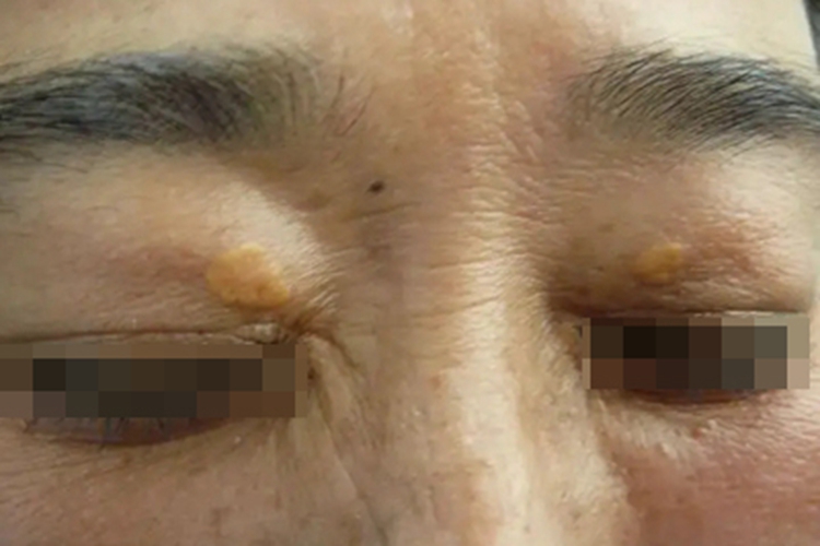 睑黄瘤上眼睑长小疙瘩图