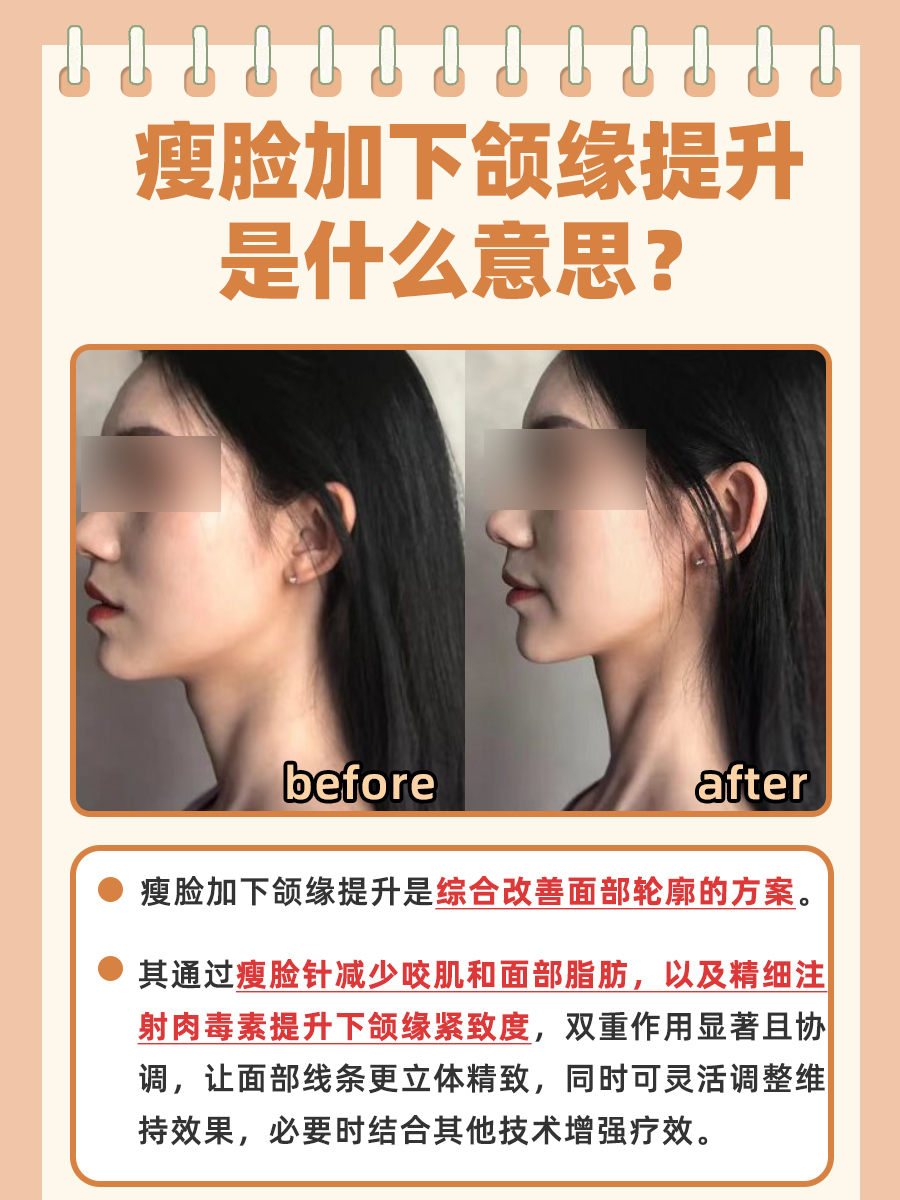 医生带你了解：瘦脸+下颌缘提升是什么？