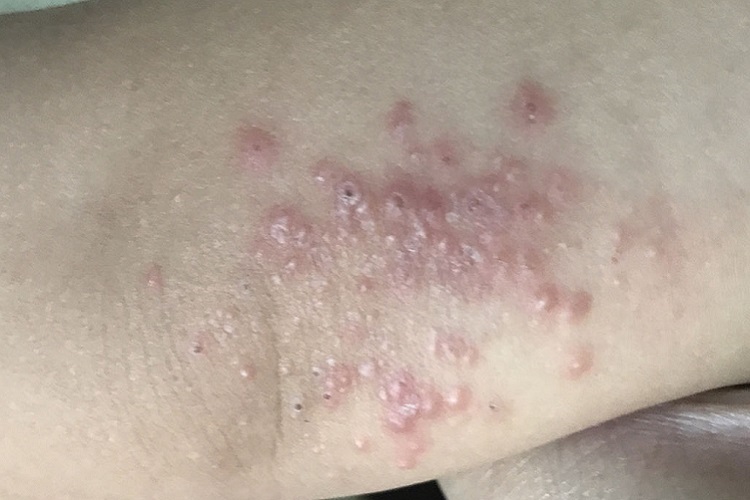 湿疹肘部水疱图 湿疹肘部水疱图