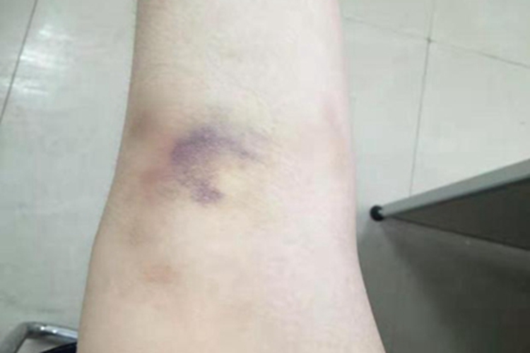 轻度扭伤膝盖皮肤发青图 轻度扭伤膝盖皮肤发青图