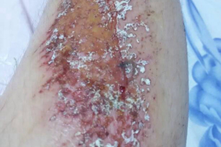 磨压伤小腿结痂图